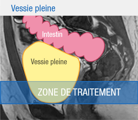 Protocole d'hydratation pour traitement avec la vessie pleine