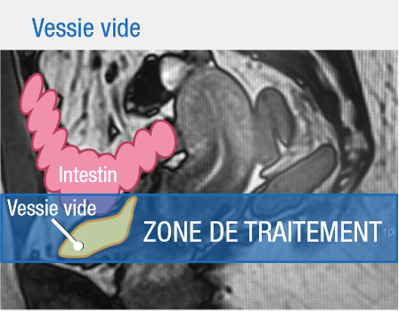 Protocole d'hydratation pour traitement avec la vessie pleine